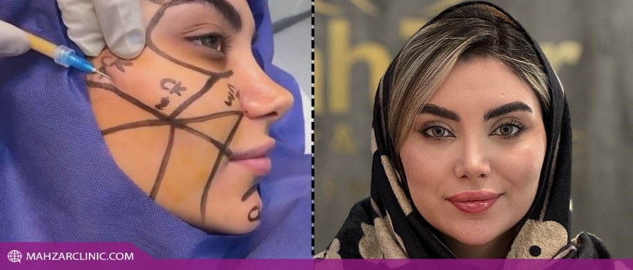 تزریق چربی فقط برای حجمدهی نیست!