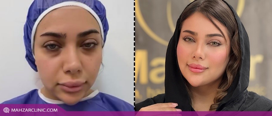 نتیجه تزریق چربی فوری و نهایی نیست!